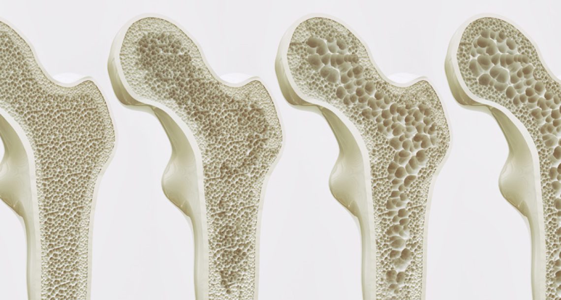 רמות AMH מנבאות קצב אובדן עצם במהלך מעבר למנופאוזה (J Bone Miner Res.)